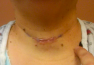 Robins_neck_post_surgery